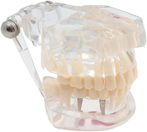 Kh66zky שיניים שתל שיניים מודל שיניים - דגם שיניים סטנדרטיות שיניים - דגם שיניים אנושיות מודל צחצוח שיניים