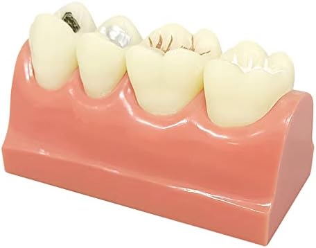 מודל לימוד שיניים של KH66Zky, מודל שיניים עששת עששת, תרגול מודל שיניים לרופא שיניים לרופאי שיניים, חולים,